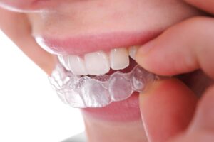 How Invisalign Works