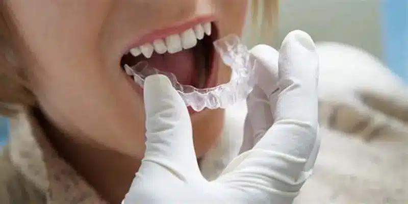 can Invisalign fix overbite
