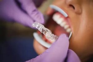 Can Invisalign correct an overbite
