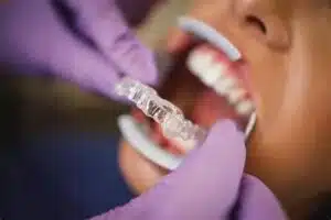 Can Invisalign correct an overbite