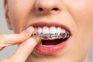 Can Invisalign help with overbite