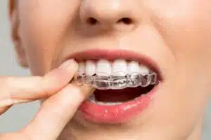 Can Invisalign help with overbite