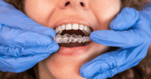 Can Invisalign treat overbite