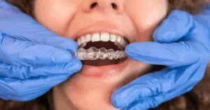 Can Invisalign treat overbite