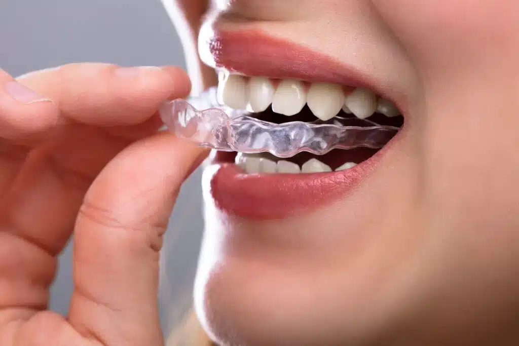 can you eat with clear aligners