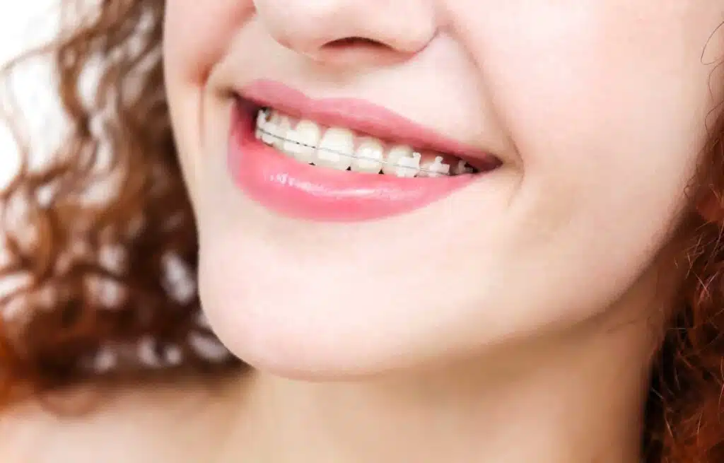 Do ceramic braces actually take longer on a woman smiling with braces
