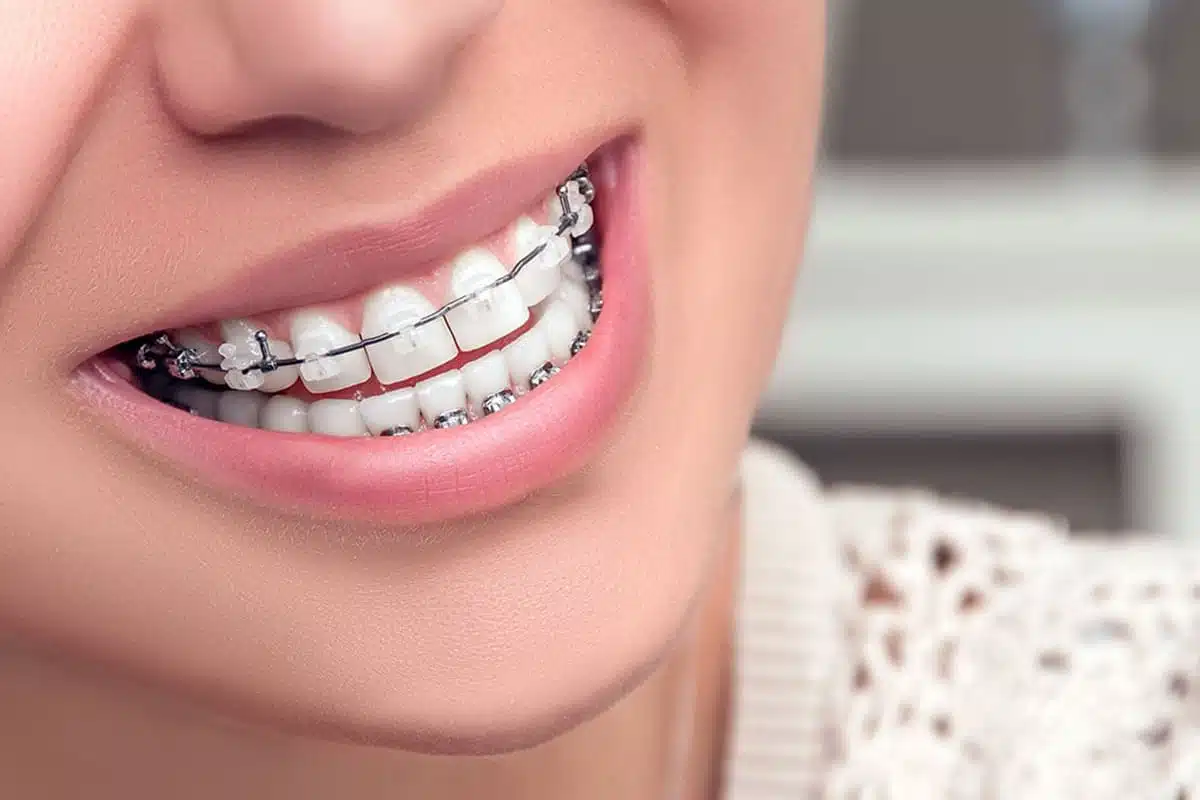 Do Ceramic Braces really Take Longer on a woman smiling with ceramic braces