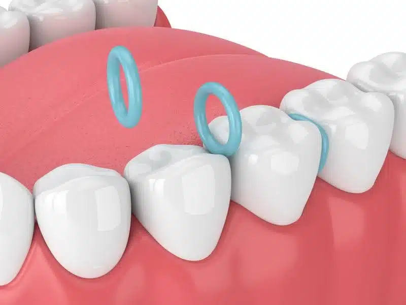 what are spacers in orthodontics