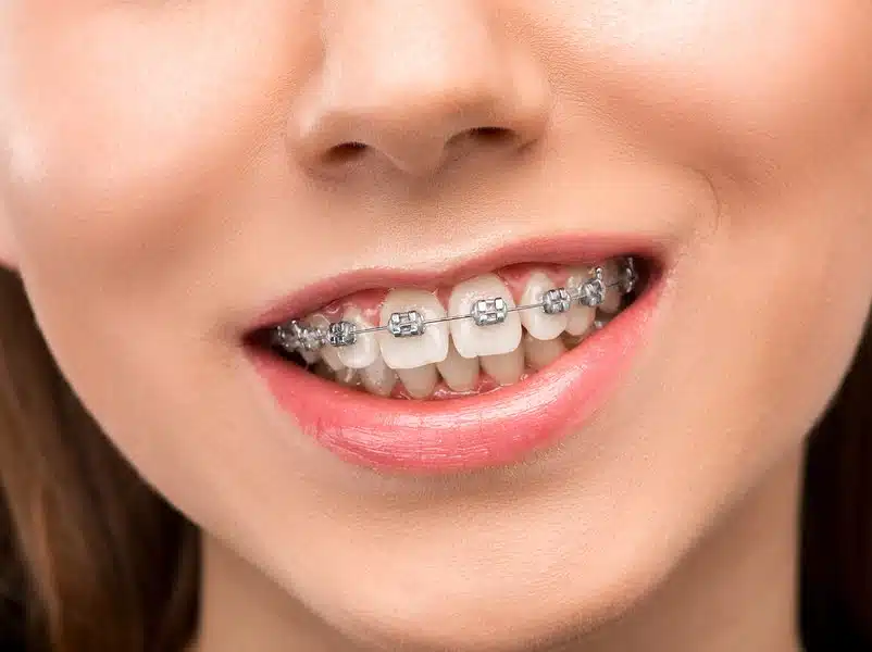 Close-up of dental braces used for overbite teeth treatment